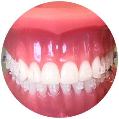 Clear braces