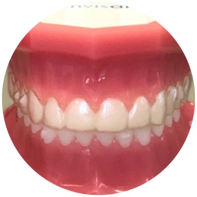 Invisalign clear aligners